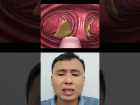 Video: 3 Cara untuk Berhenti Merokok dengan Kaedah Turki Sejuk