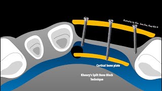 Bone and soft tissue augmentation inspired by Prof. F. Khoury Dr Alex Hong screenshot 1