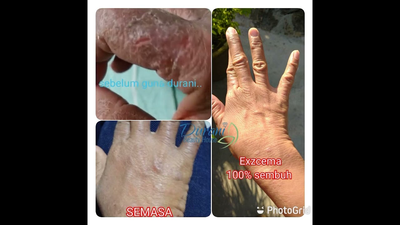 Kulit Bebas Gatal Pakar Rawatan Kulit