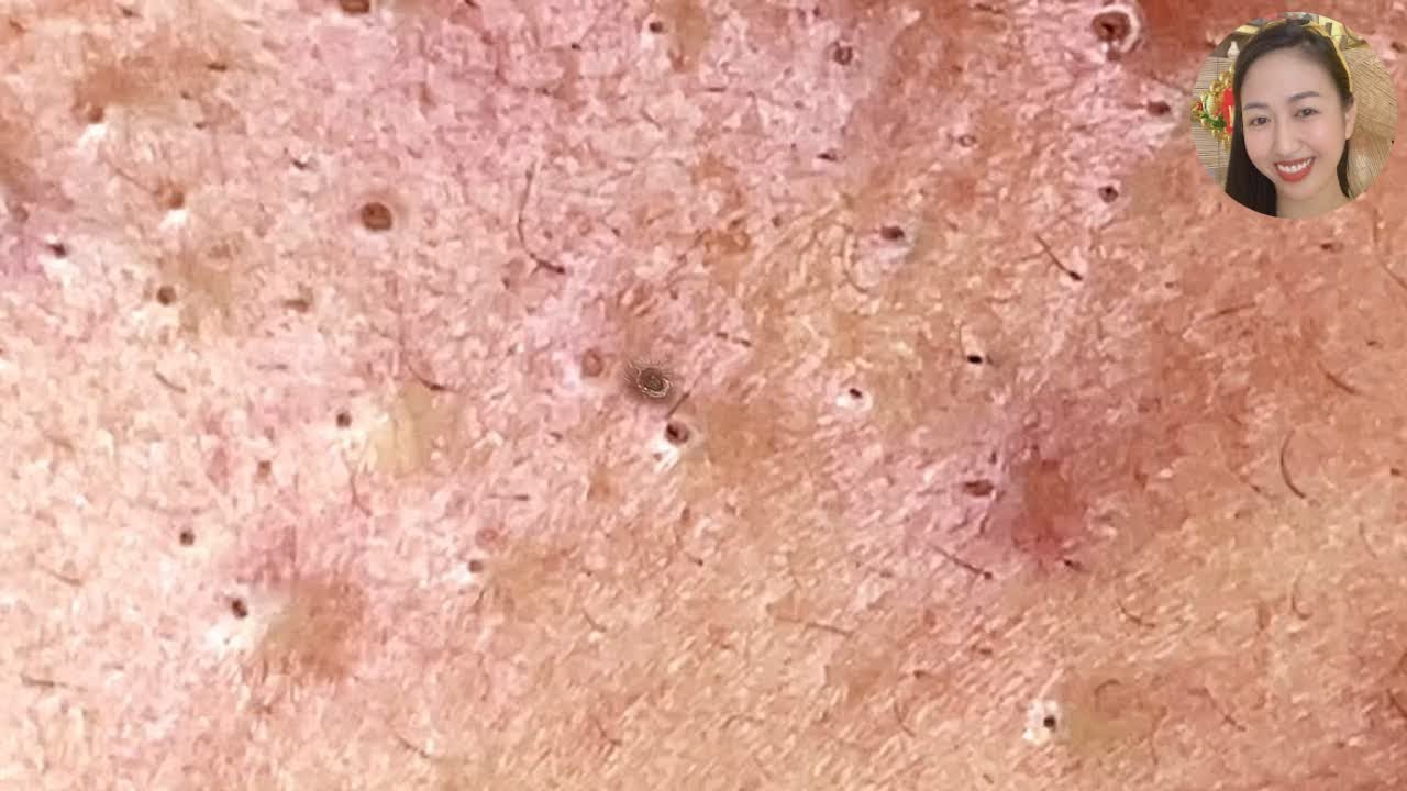 Acne Treatment 2021 - Relaxing With Blackhead Removal Videos #22 - YouTube