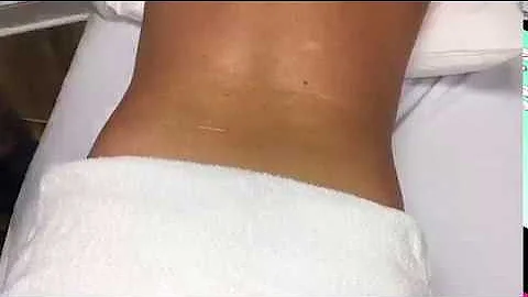 Laser Hair Removal (lower back) by CLT Christy Wal...