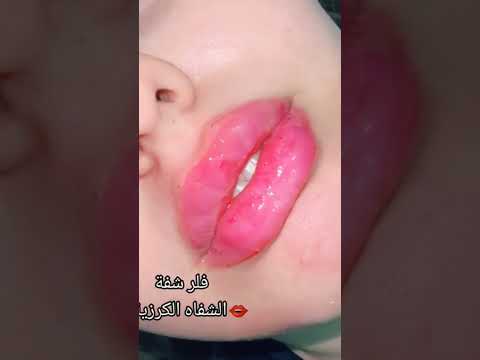 فلر شفة الشفاه الكرزية من مجمع النور الطبي