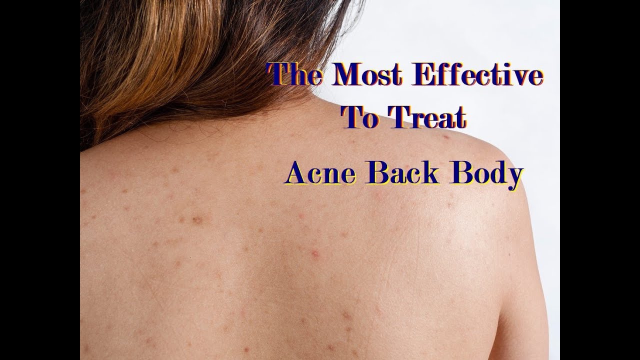 Milia The most effective way to treat acne on the body Rid of Acne