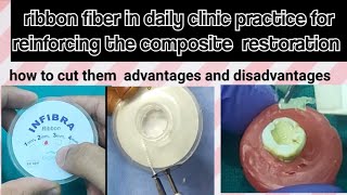 Ribbon fiber composite restoration in daily clinic practice 