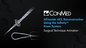 All-Inside ACL Reconstruction Using the Infinity™ Knee System - CONMED Animation