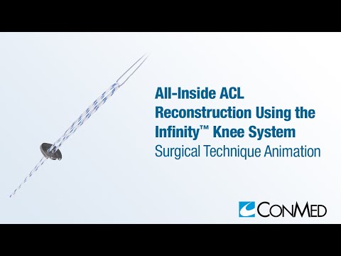 All-Inside ACL Reconstruction Using the Infinity™ Knee System - CONMED Animation