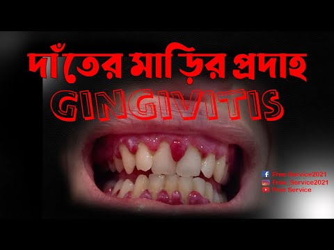 Gingivitis with Causes of Gum Bleeding ।। দাঁত ও মাড়ির প্রদাহ মাড়ি থেকে রক্ত পড়ার কারন জেনে রাখুন।