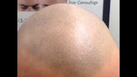 Scalp Micropigmentation and Stunning Results with Chris 3D