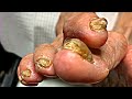 Can this 93-YEAR-OLD patient have surgery on her deformed toes?! (Satisfying Nail Cutting)