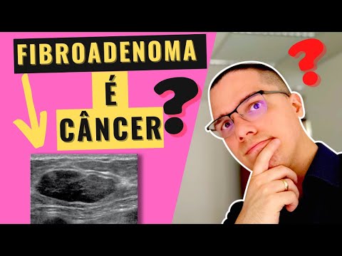 Vídeo: Fibroadenoma Da Mama: Causas, Sintomas E Diagnóstico