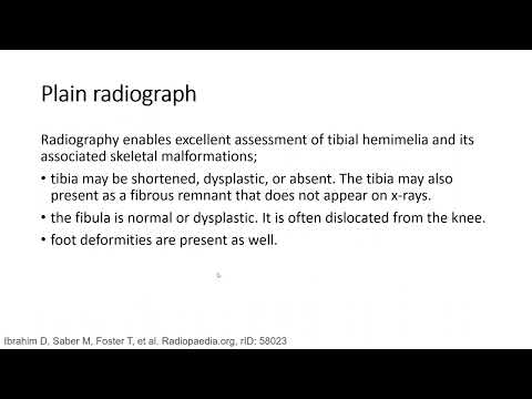Tibial Hemimelia Imaging