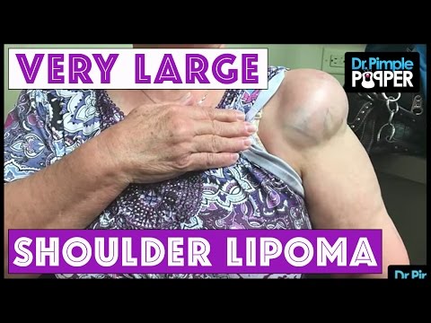 Updates: A True Over The Shoulder Boulder Holder With One Month Update!