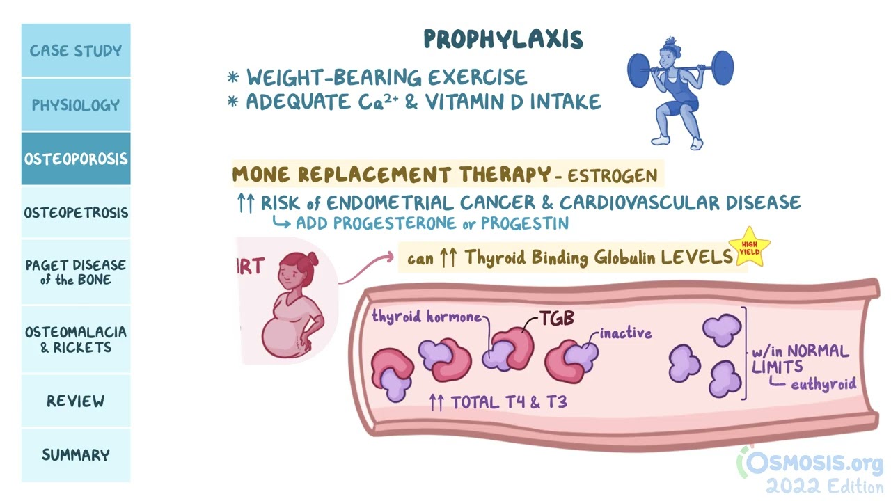 Osteoporosis, Osteopetrosis, Paget Disease, Rickets | Orthopedics | Osmosis Pathology Review
