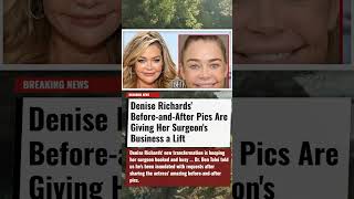 Denise Richards' Before and After Pics Are Giving Her Surgeon's Business a Lift