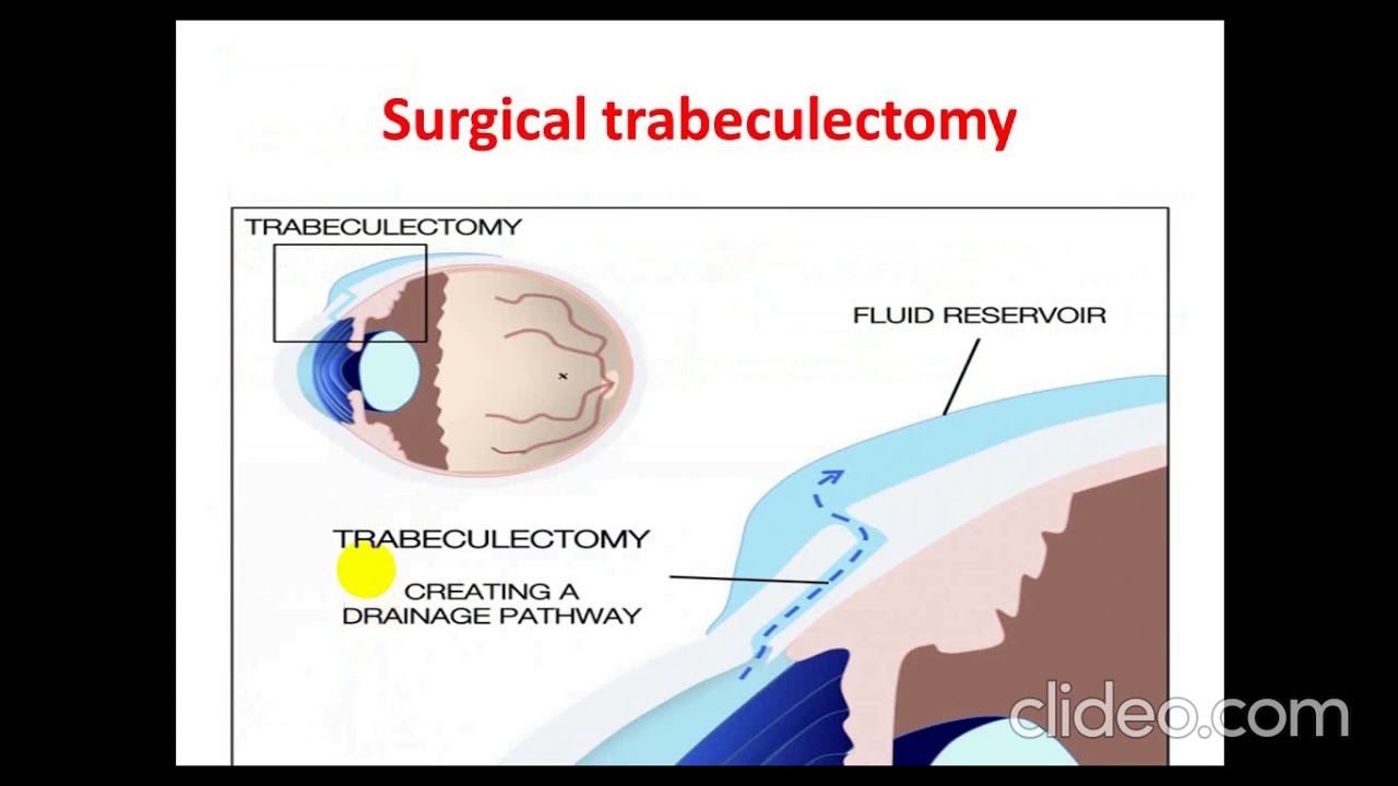 Glaucoma. By Dr. Dheyaa Jabbar