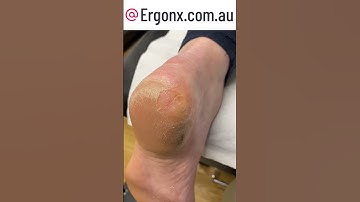 Cracked Heel Transformation: Amazing Pain-Free Removal Process Revealed #FootCare #SmoothHeels
