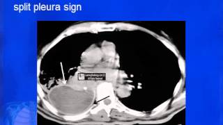 para pneumonic effusion