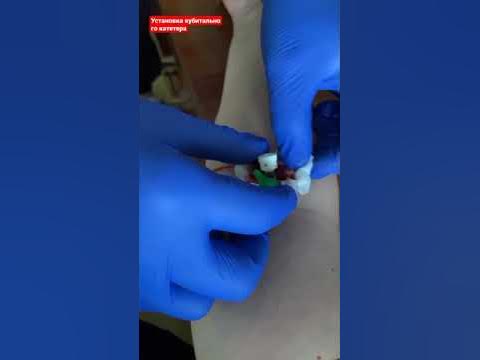 установка внутривенного периферического катетера /флекса/ кубитальный ...