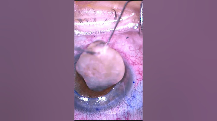 Open Sky Cataract Surgery and Corneal Transplant