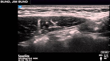 Rectus Sheath Block (A Local Anaesthetic Forever Story)