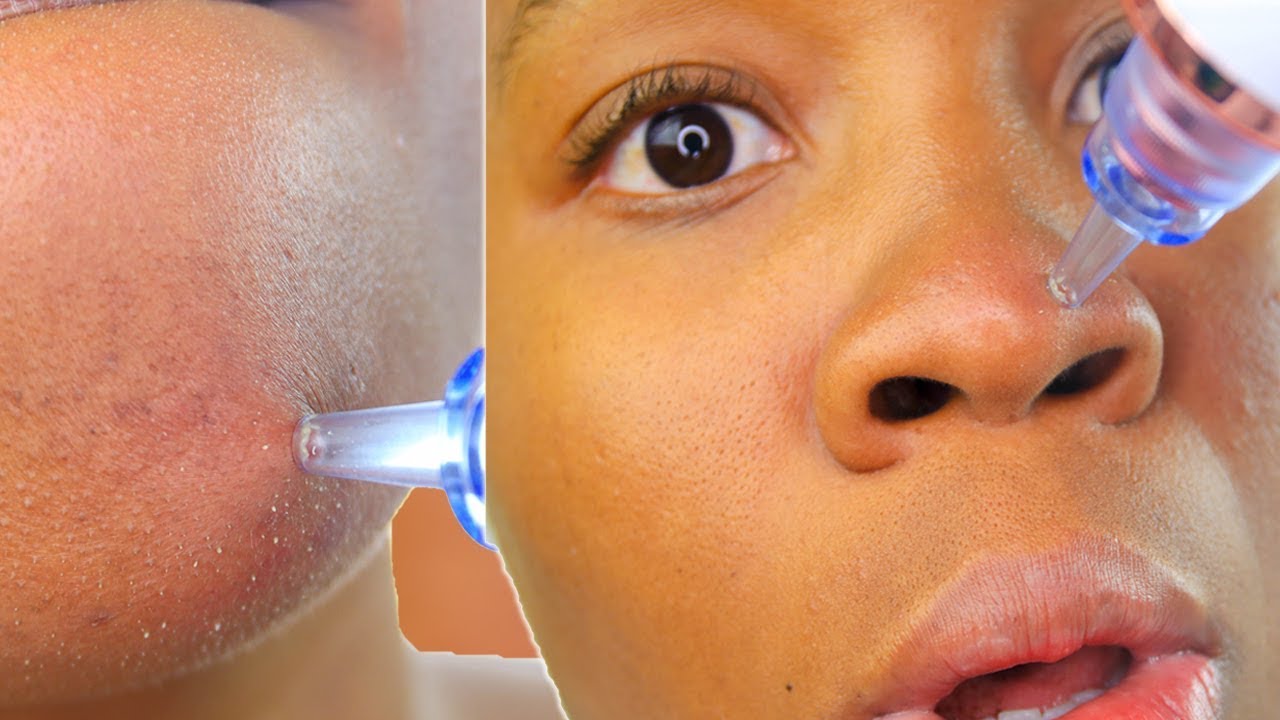 I tried the BLACKHEAD Vacuum! Vacuum Pore Cleaner! PORE + BLACKHEAD