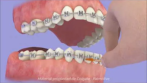 ¿Es adecuado el enjuague bucal para los aparatos de ortodoncia?