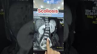 MRI L.S spine, finding- Scoliosis #technologist #viralvideo #radiology