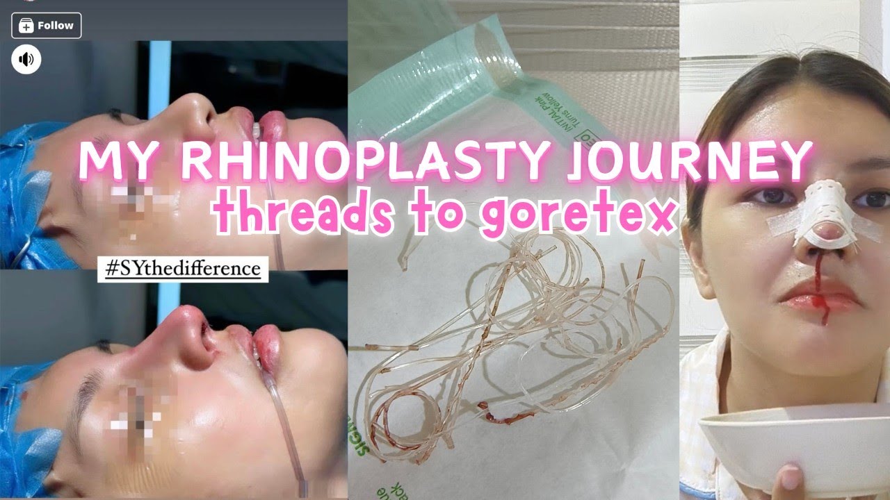 Thread Absorbable Rhinoplasty I DID IT! Hiko Threads to Goretex Rhinoplasty | Doctor, Price ...