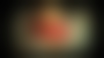 Hip Luxation Repair using Arthrex Tightrope/Toggle Pin System