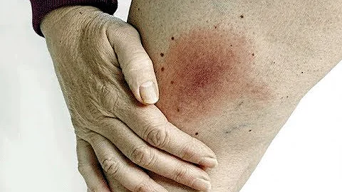 Come si cura la malattia di Lyme nel cane?