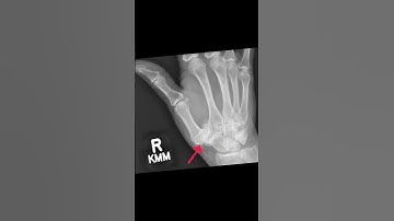 Thumb joint replacement surgery #Thumb #Surgeon #OrthopedicSurgeon #Arthritis #medicalstudent