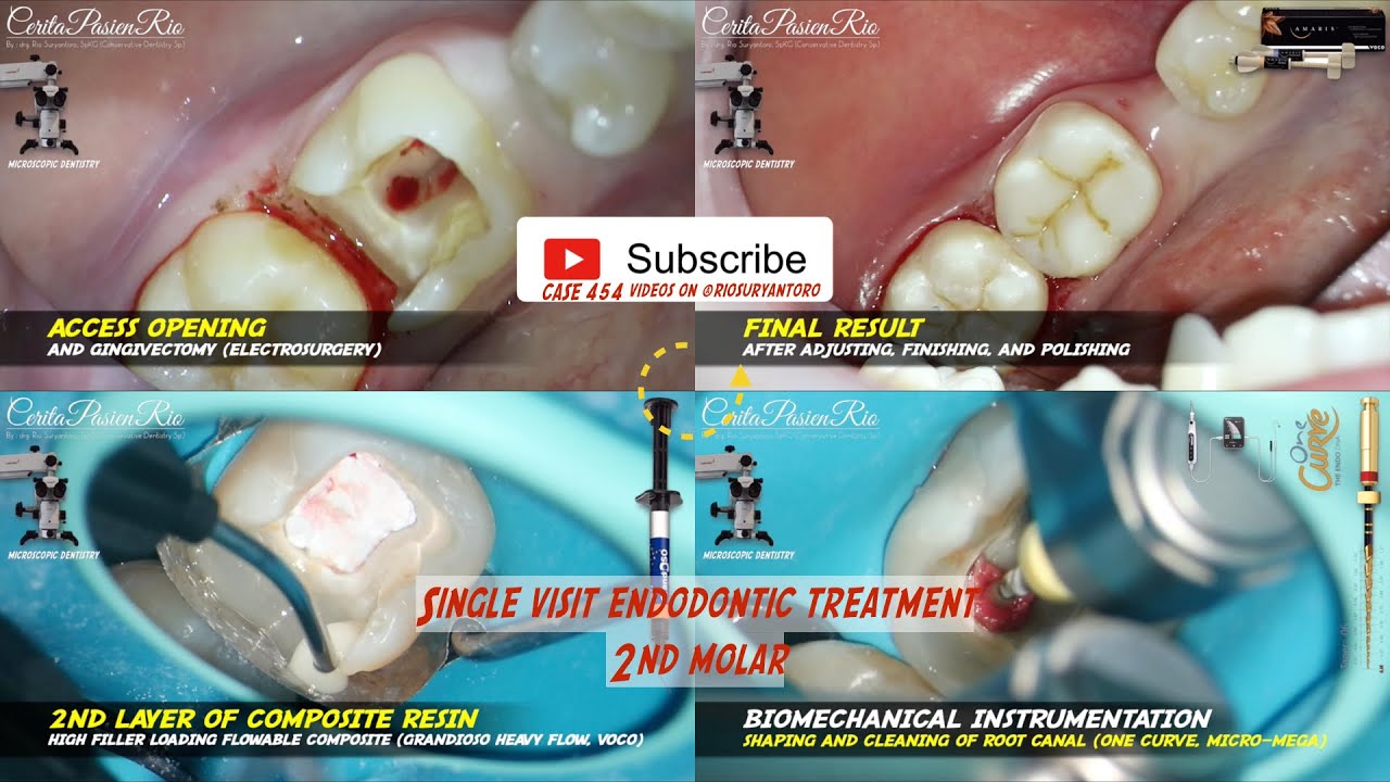 single visit endodontics