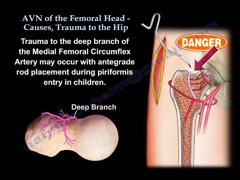 Download AVN Femoral Head  Causes, Trauma To The Hip - Everything You Need To Know - Dr. Nabil Ebraheim