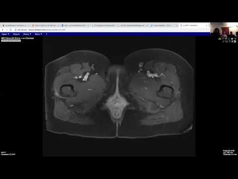 Video: Terapi Menangkap Neutron Boron Untuk Melanoma Vulvar Dan Penyakit Kelamin Ekstremammary Genital Dengan Tindak Balas Yang Mengubati