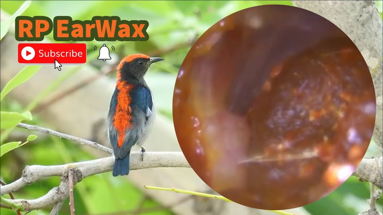 Ear Cleaning episode#30 - It Is Recommended Not To Use Ear Candles To