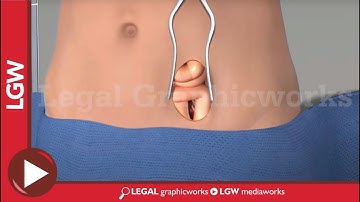 Anterior Lumbar Fusion Surgery L5 S1 3D animation