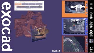exocad Video Tutorial: exoplan screenshot 2