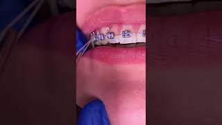 How do rubber bands work with braces? Tooth Time Family Dentistry New Braunfels Texas