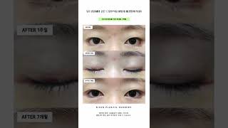 뒤트임실패와 같은 트임부작용 어떻게 해결할까(복원) #시선성형외과 #shorts