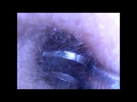 12 Ear Wax Removal 耳毛をピンセットで抜く動画 I Remove The Ear Hair With Tweezers Ear Cleaning Earpick Youtube