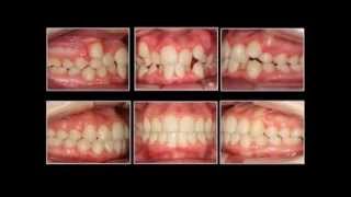 Caso 1. Apiñamiento dental severo. Sistema Autoligable Damon.