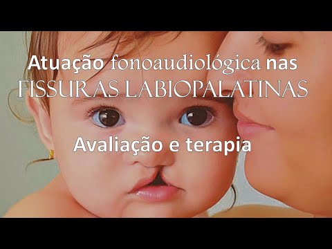 Atuação Fonoaudiológica nas Fissuras Labiopalatinas.