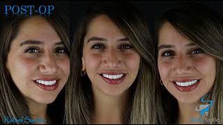 Smile Makeover