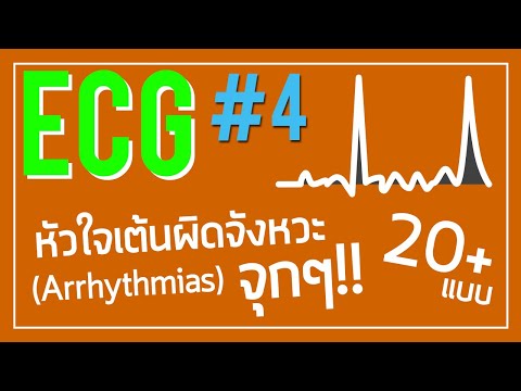 ECG #4: หัวใจเต้นผิดจังหวะ มีแบบไหนบ้าง จะเห็น EKG แบบไหน!!