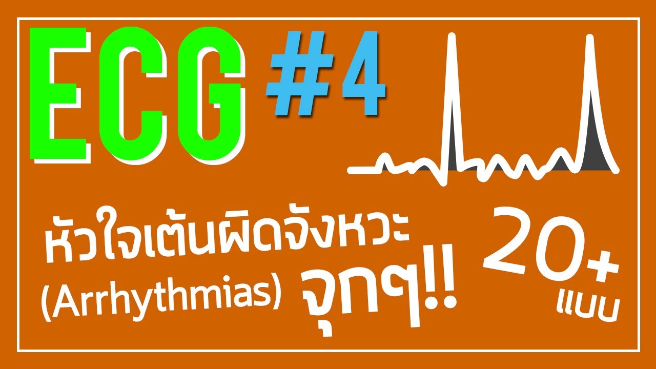 ECG #4: หัวใจเต้นผิดจังหวะ มีแบบไหนบ้าง จะเห็น EKG แบบไหน!!