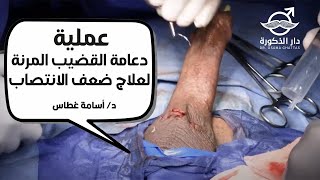 عملية دعامة القضيب المرنة لعلاج ضعف الانتصاب |  الدكتور اسامة غطاس