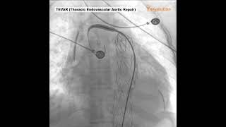 TEVAR Thoracic Endovascular Aortic Repair performed on Pinnacle Agile