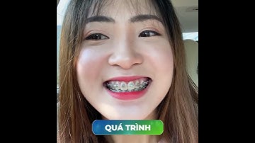 Niềng răng đã thay đổi tôi như thế nào? #shorts