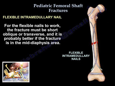 Pediatric Femoral Shaft Fractures - Everything You Need To Know - Dr. Nabil Ebraheim