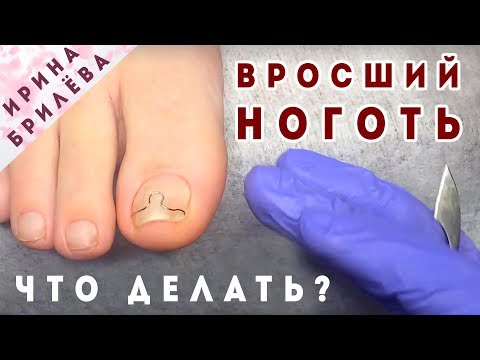 Вросший ноготь на ноге ⚡ЧТО ДЕЛАТЬ? Советы профессионала